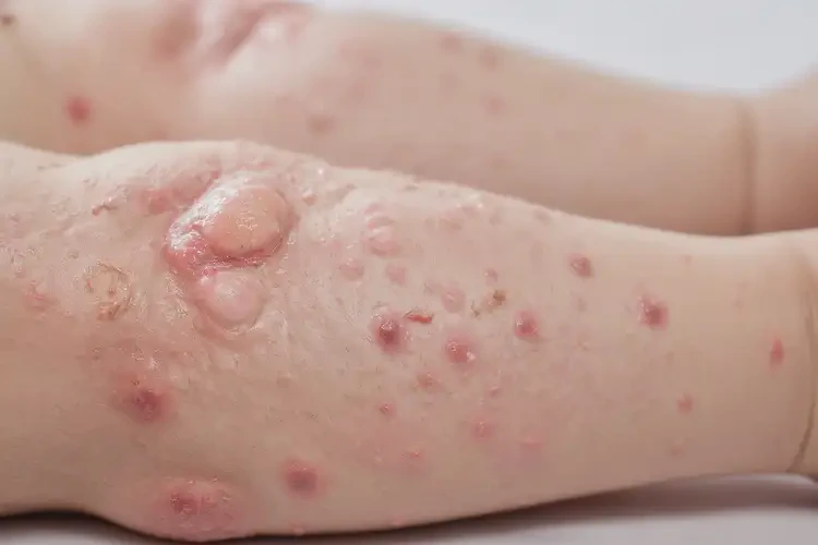 兒童四肢經常起濕疹能徹底自愈嗎(圖4)