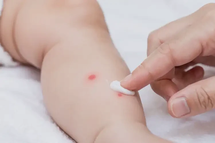 新生兒小腿上經(jīng)常起濕疹不管它會(huì)自己自愈嗎(圖3)