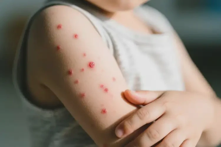 小孩手臂上偶爾起濕疹能靠自己自愈嗎(圖4)