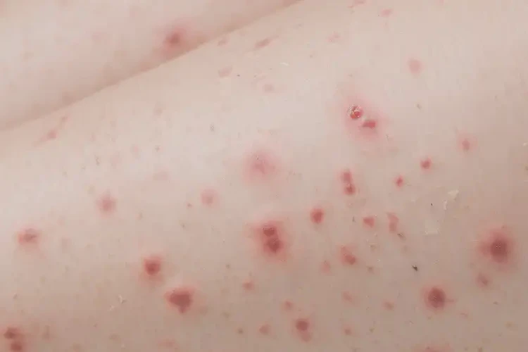 小學生大腿容易長濕疹能徹底自愈嗎(圖4)