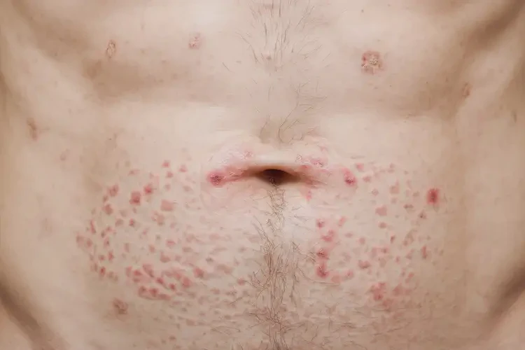 男性肚子上有濕疹可不可以徹底自愈(圖3)