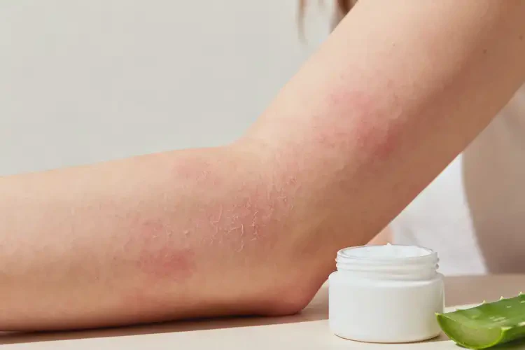 女性手臂出現(xiàn)濕疹可以徹底自愈嗎(圖2)