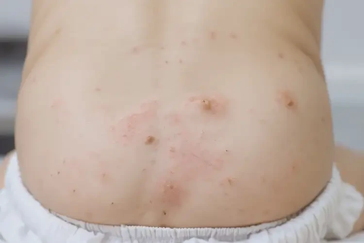 儿童肛周偶尔起湿疹可不可以彻底自愈(图4)