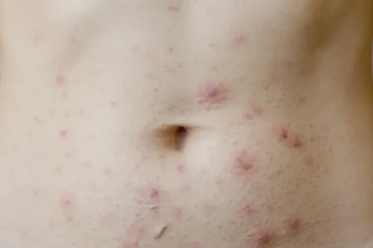 女人肚子偶爾長濕疹可以徹底自愈嗎(圖4)