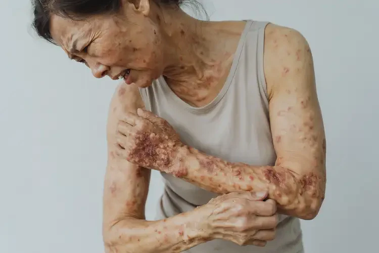 女性全身有濕疹能靠自己自愈嗎(圖4)