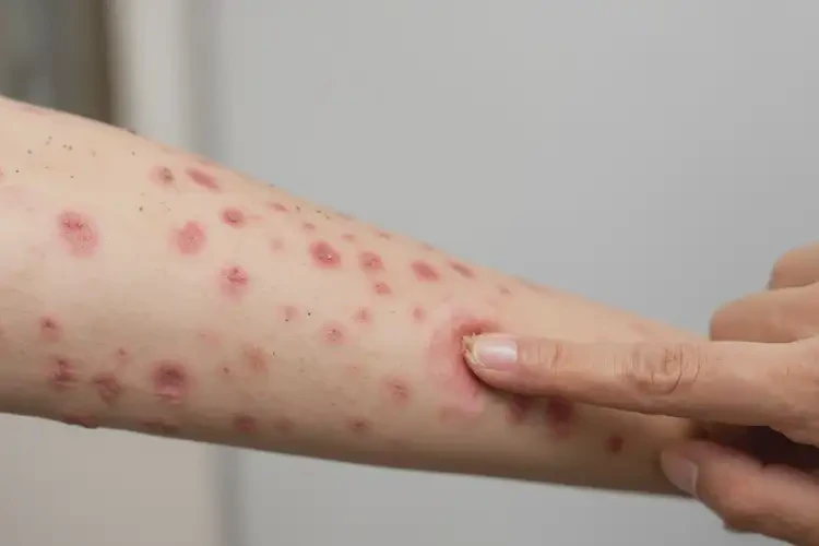 女生身上偶爾長(zhǎng)濕疹可以徹底自愈嗎(圖3)