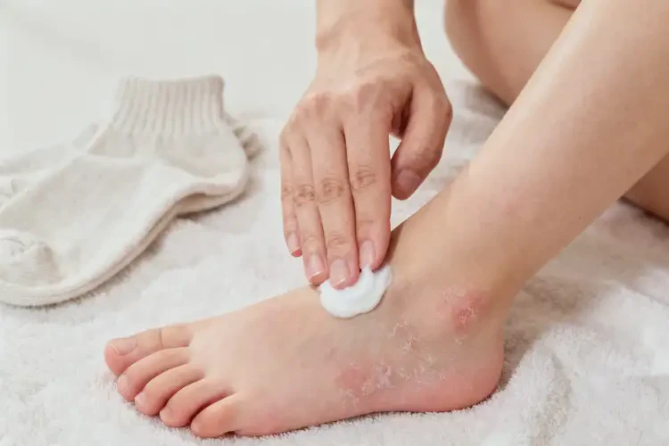 孩子腳上經(jīng)常起濕疹能靠自己自愈嗎(圖4)