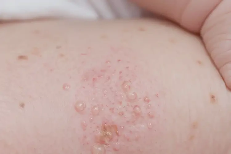 新生兒全身出濕疹不管它會自己痊愈嗎(圖4)