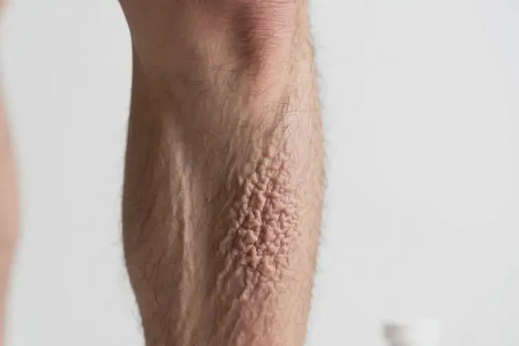 男人小腿長濕疹不管它會自己自愈嗎(圖3)