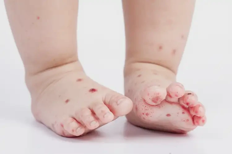 少兒腳上出現(xiàn)濕疹可不可以徹底自愈(圖2)