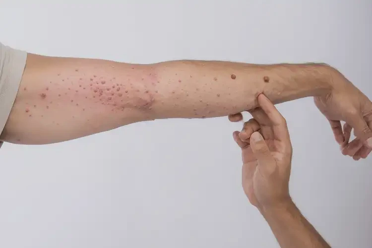 青年人手臂上容易長(zhǎng)濕疹不管它會(huì)自己自愈嗎(圖4)