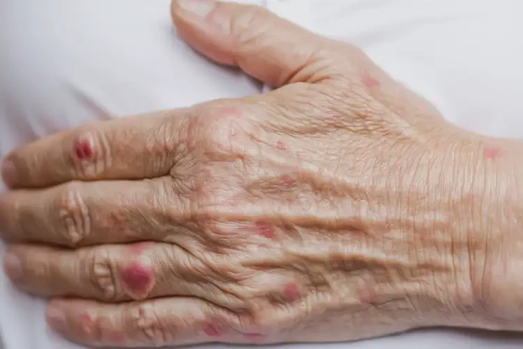 老年人手上偶爾長(zhǎng)濕疹不管它會(huì)自己自愈嗎(圖4)
