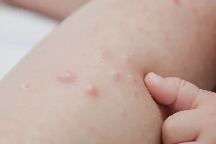 宝宝大腿容易起湿疹能够彻底治愈吗(图4)