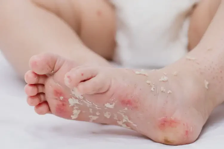 幼兒腳上經(jīng)常起濕疹可不可以徹底自愈(圖4)