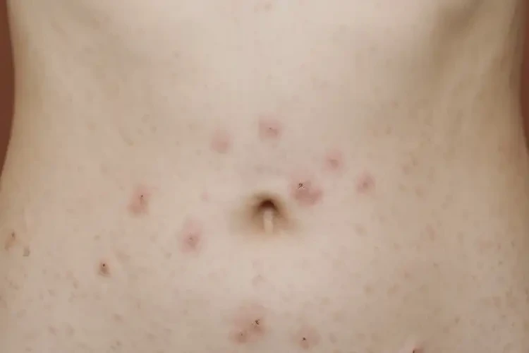 女生肚子上偶爾起濕疹不管它會自己自愈嗎(圖4)