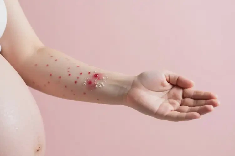 產(chǎn)婦手臂出現(xiàn)濕疹可不可以徹底自愈(圖1)