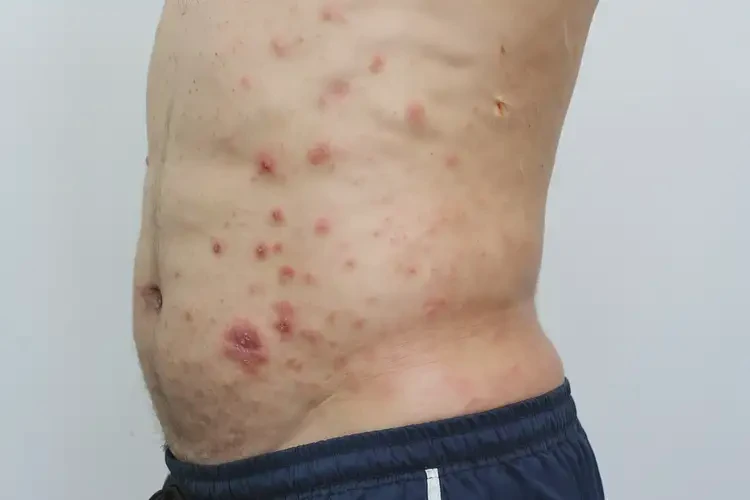 男性屁股上有濕疹能靠自己自愈嗎(圖4)