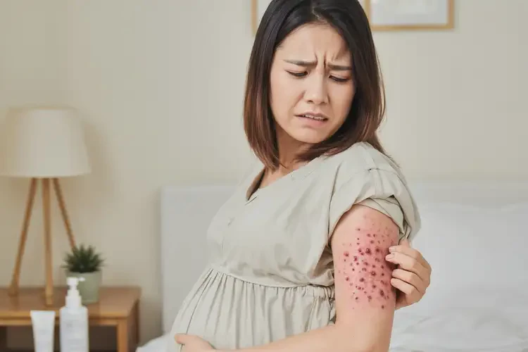 孕婦手臂上有濕疹能徹底自愈嗎(圖4)