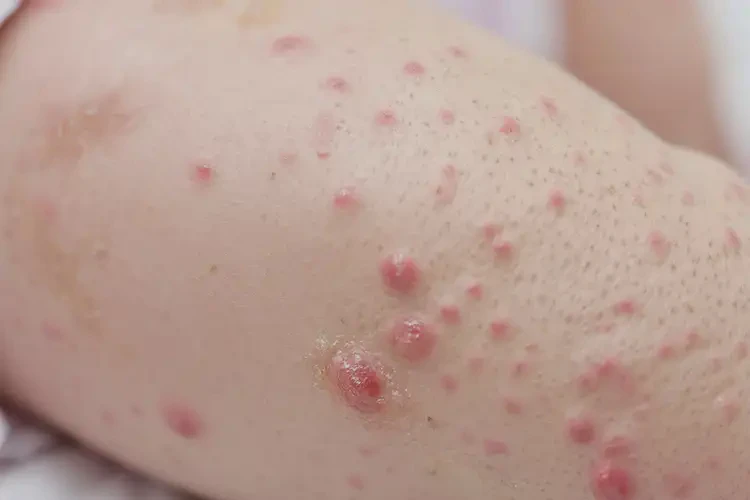 嬰兒小腿容易起濕疹不管它會自己好嗎(圖4)