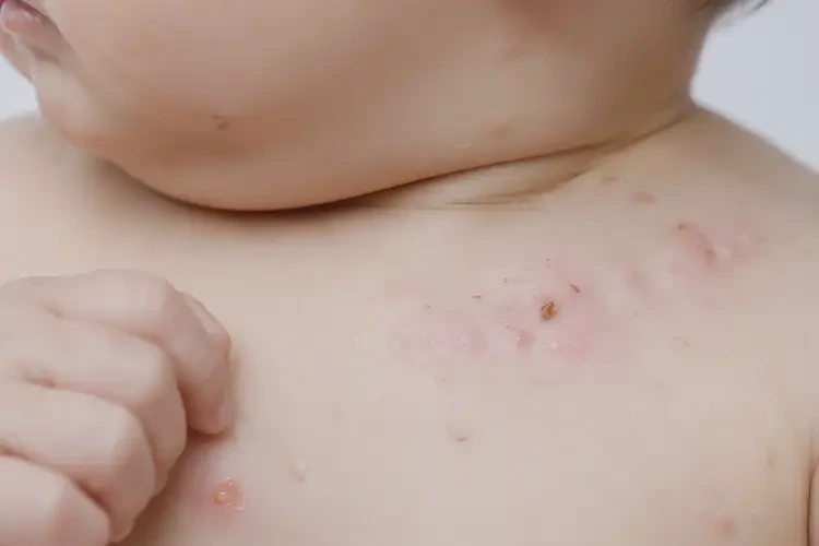 嬰兒脖子有濕疹可以徹底自愈嗎(圖4)