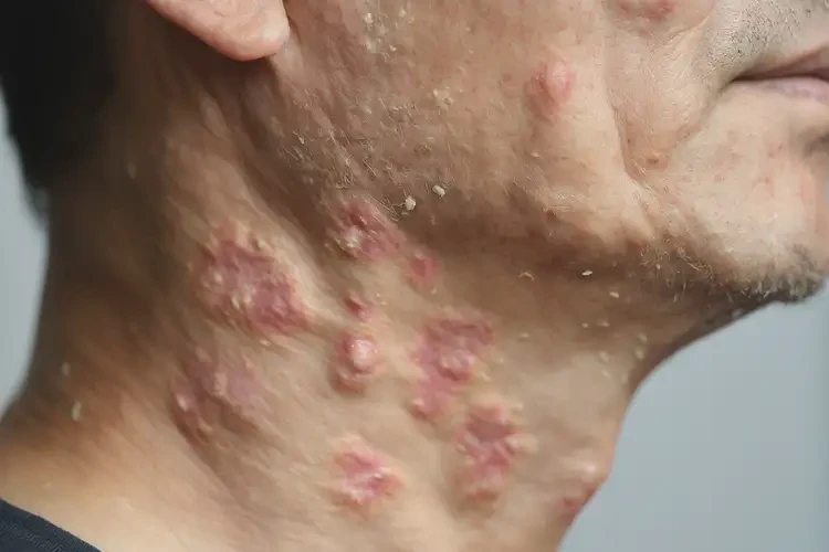 男人脖子偶爾長濕疹能不能徹底自愈(圖4)