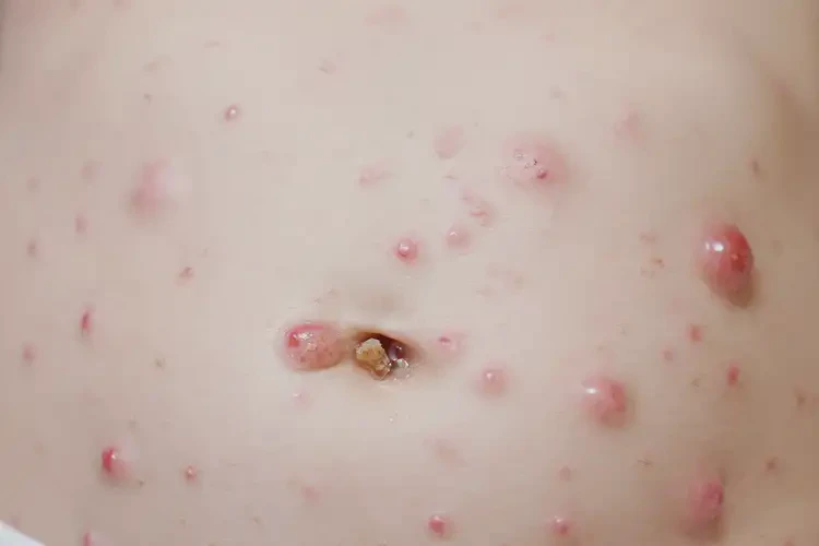 孩子肚子出湿疹可以彻底自愈吗(图4)