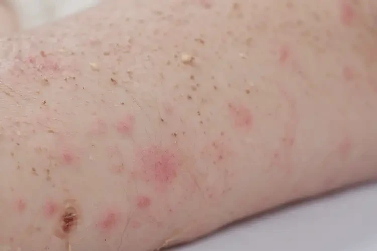 孩子四肢起濕疹能徹底自愈嗎(圖4)