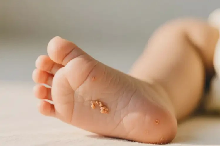 幼兒腳上容易起濕疹不管它會(huì)自己痊愈嗎(圖3)