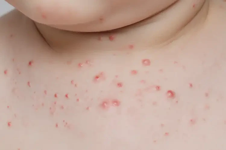 幼兒脖子容易長濕疹不管它會自己自愈嗎(圖4)