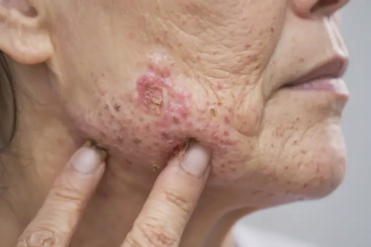 女性脖子上容易起濕疹可以徹底自愈嗎(圖4)