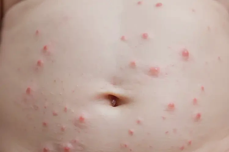 新生儿肚子经常长湿疹能够彻底治愈吗(图4)