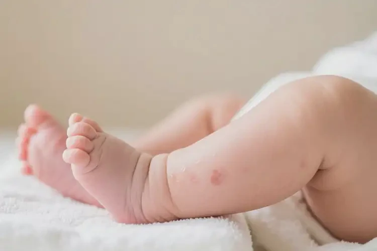 新生儿四肢有湿疹不管它会自己痊愈吗(图1)