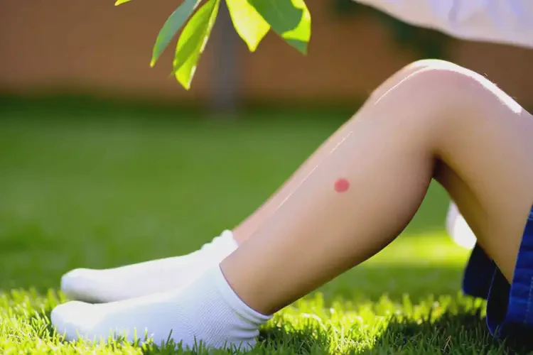 孩子小腿上出現(xiàn)濕疹不管它會自己痊愈嗎(圖4)