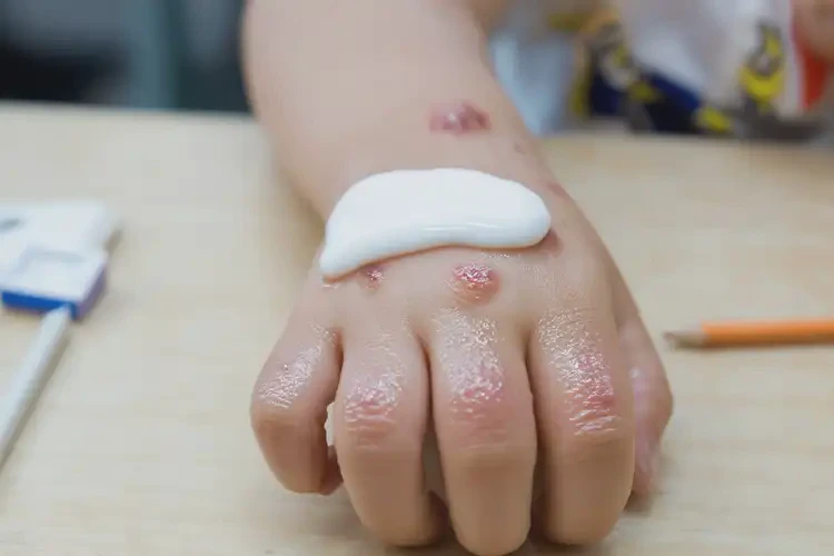 小學生手上容易起濕疹能不能徹底自愈(圖3)