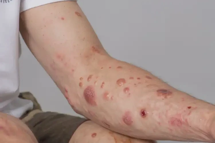 青年人四肢起濕疹不管它會(huì)自己自愈嗎(圖4)