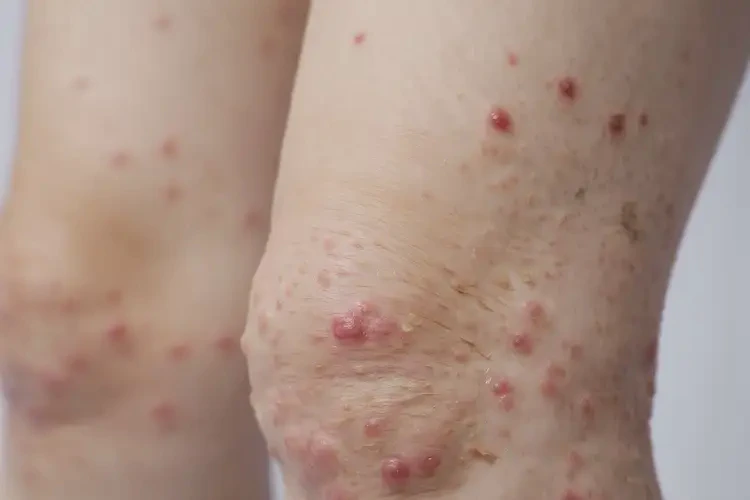 小学生小腿出湿疹能彻底自愈吗(图4)