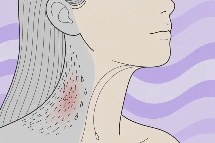 女生脖子上容易起濕疹可不可以徹底自愈(圖1)