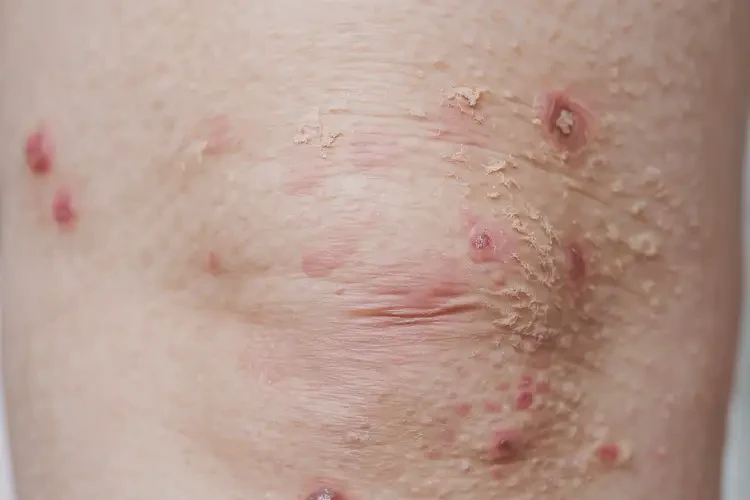 小兒大腿上經(jīng)常起濕疹不管它會自己好嗎(圖4)