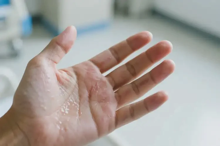 青少年手上出濕疹能徹底自愈嗎(圖3)