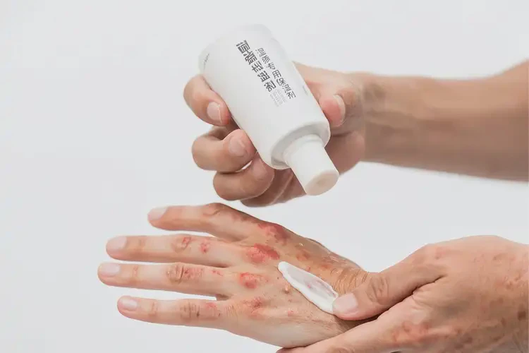 男生手上出湿疹能靠自己自愈吗(图2)