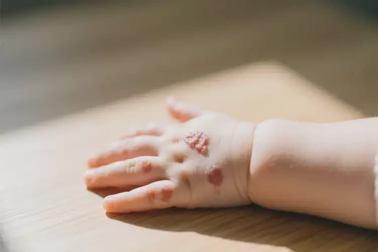 婴幼儿手上出湿疹能靠自己自愈吗(图2)