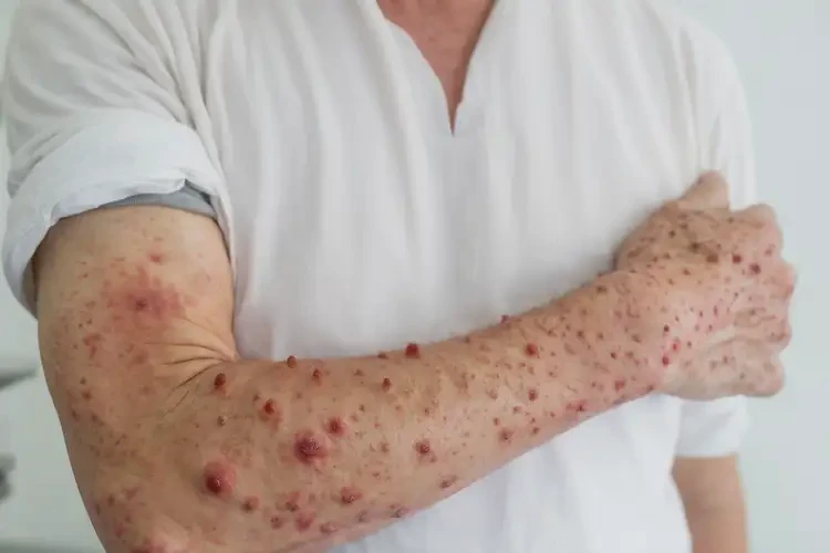 男人手臂上起濕疹能徹底自愈嗎(圖3)