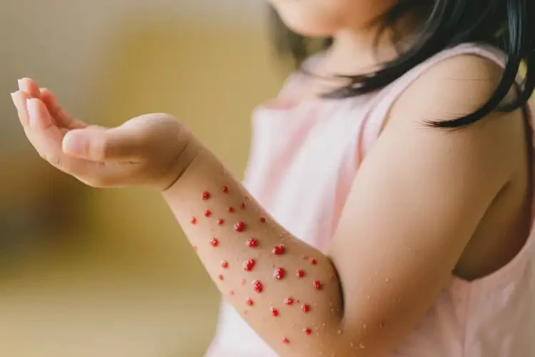 小兒手臂上起濕疹能徹底自愈嗎(圖3)