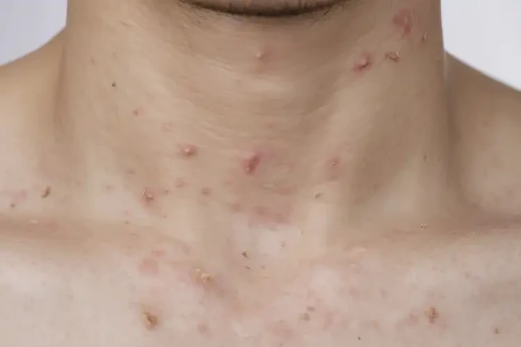 男生脖子上偶爾長濕疹不管它會自己痊愈嗎(圖4)