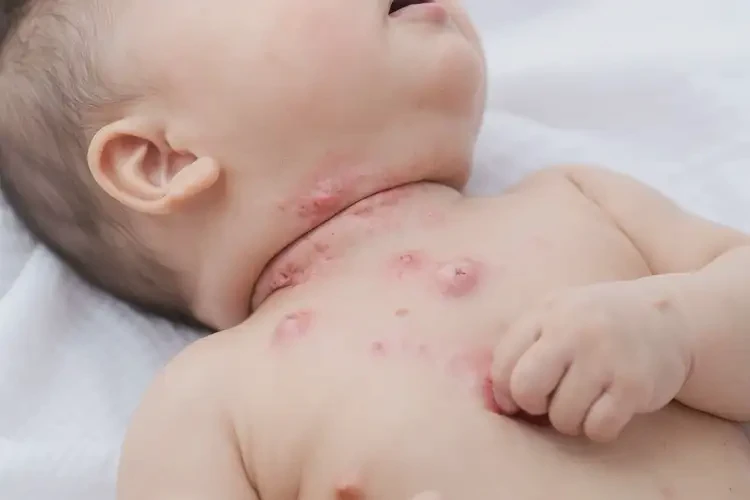 嬰兒脖子上有濕疹能徹底自愈嗎(圖3)