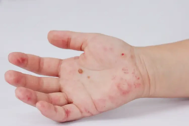 小孩手上長濕疹不管它會(huì)自己好嗎(圖3)