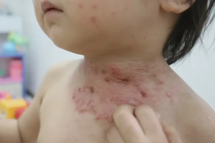 孩子脖子上容易起濕疹不管它會自己好嗎(圖4)