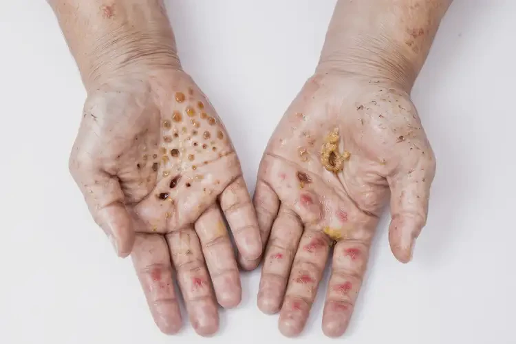 女性手上起濕疹不管它會自己好嗎(圖2)