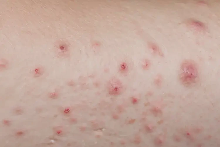 青少年身上容易起湿疹不管它会自己痊愈吗(图4)