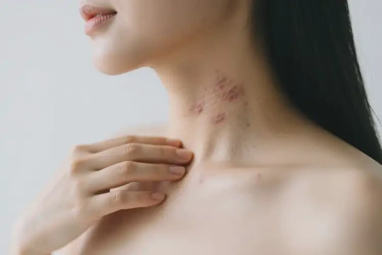 孕婦脖子上出濕疹不管它會自己自愈嗎(圖4)